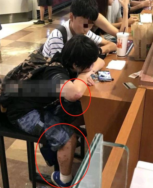 童星小小彬，被亲爸后妈榨干1800万后，皮肤溃烂