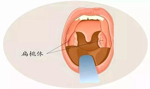 扁桃体发炎，咽喉肿痛，针对这种常见疾病，应该如何应对才好？