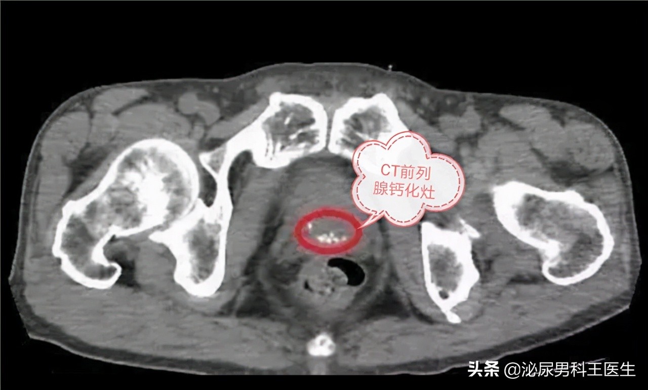 Prostate Calcification Does prostate calcification have any effect on health?Can the treatment ...