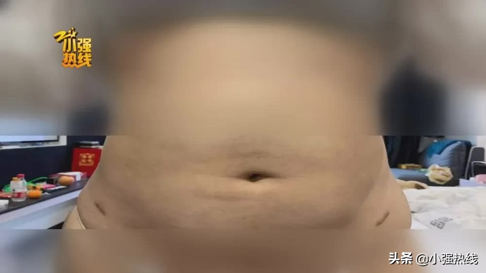 140斤的姑娘抽脂减肥,一次性抽掉4000毫升脂肪