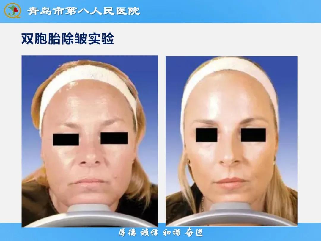 健康科普大赛获奖作品展示⑭丨肉毒毒素微整注射