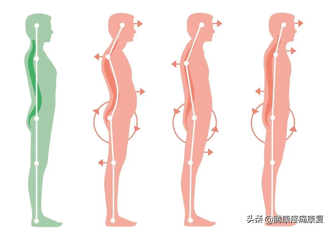 頭部前傾的危害與矯正 - 資訊咖