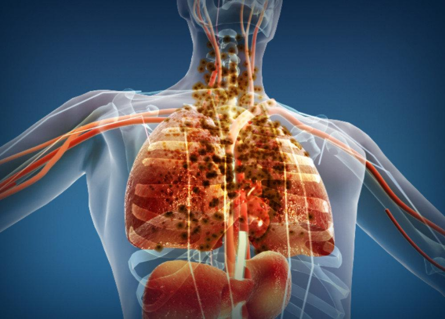 身體出現6種跡象，說明肺部毒素較多，3件事傷肺的事別再做