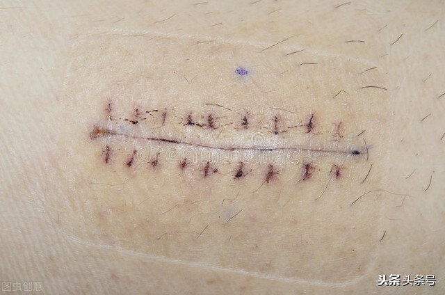 How does the scar constitution form? - iNEWS