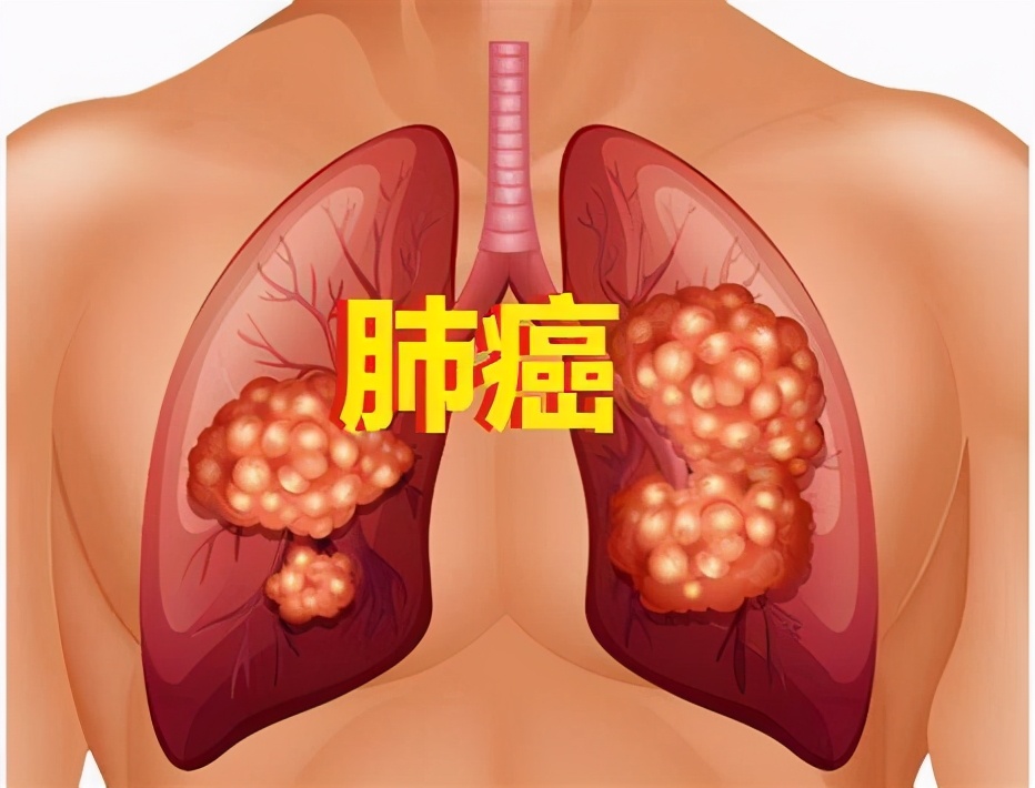 肺癌一线免疫治疗！治疗PD-L1高表达肺癌显著延长总生存期