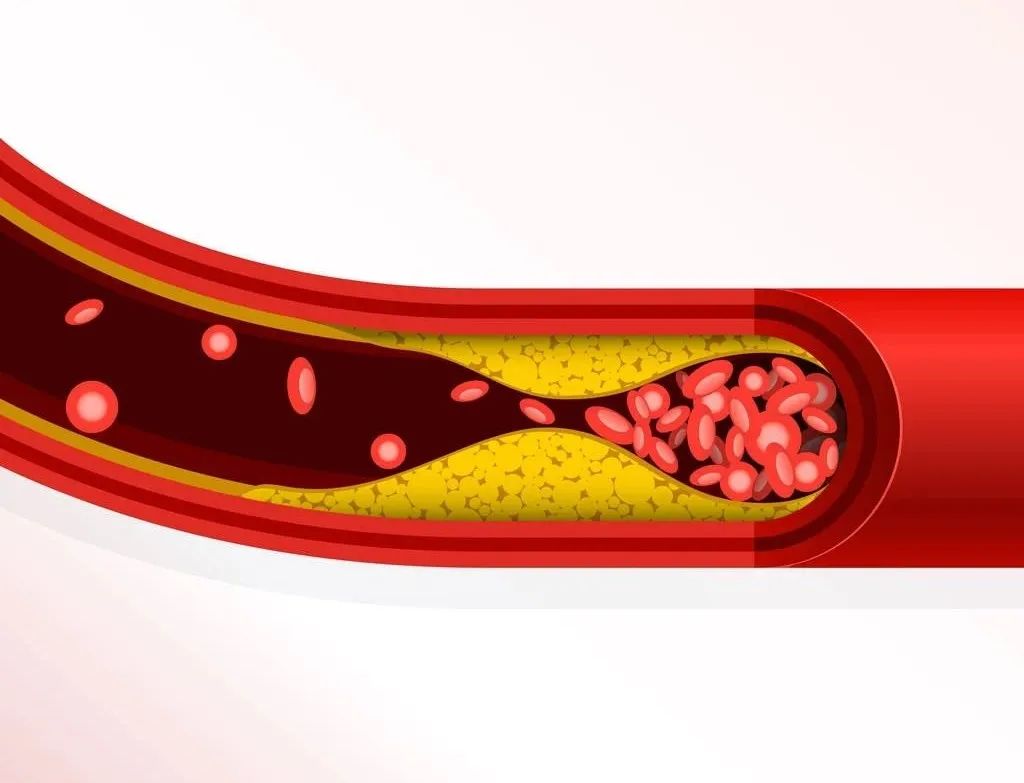 听说血管越硬越短命，软化血管的食物有哪些？