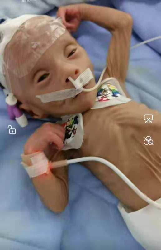 考虑到宝贝胃肠不耐受,营养不够,给予静脉补充,因为疾病影响,精神差