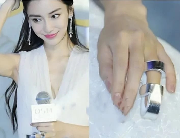 综艺节目有多危险：杨颖手指骨折，宋小宝反复