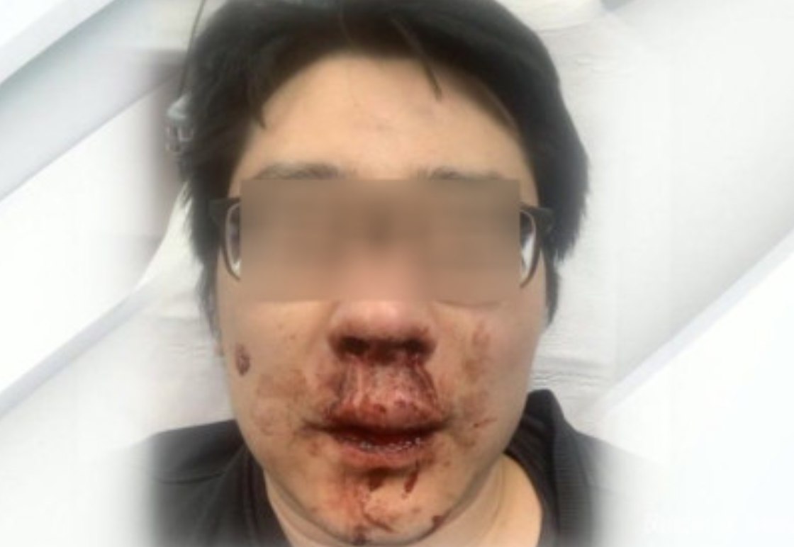 “中国病毒 滚出英国！”中国老师在英国被4人围殴谩骂，被打得满脸血