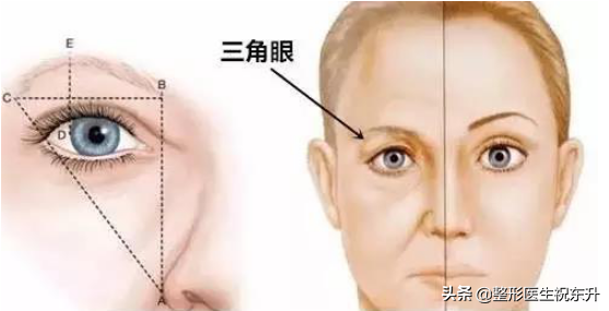 提眉手术什么年龄做合适？听说它与"割双眼皮"有相似之处...