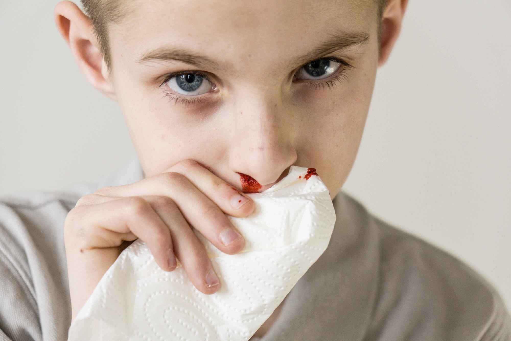 经常流鼻血的原因,或是这6种原因引起，注意规避!