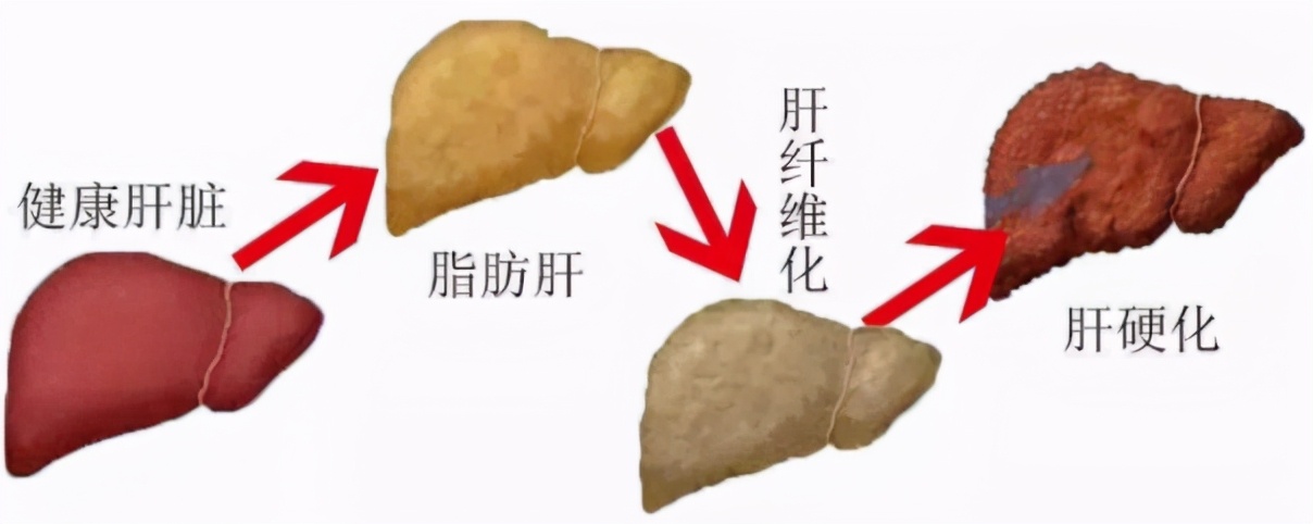 脂肪肝可能发展成肝癌，得了脂肪肝要怎么办？