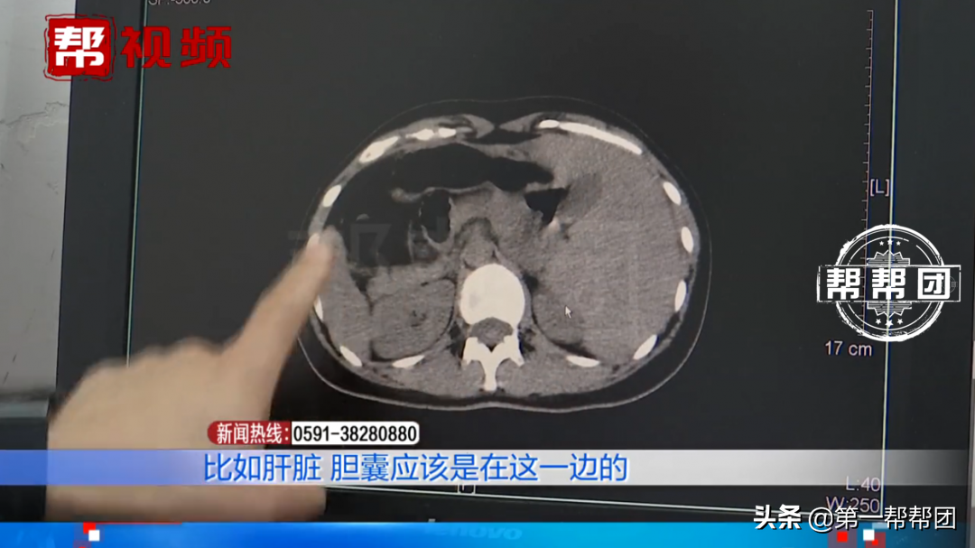 女子腹痛入院，医生检查后大吃一惊，器官竟全