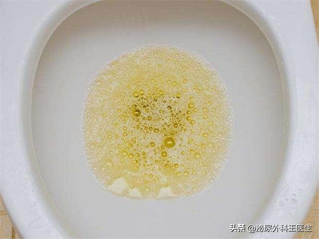 Foamy urine is proteinuria, is it renal insufficiency?The doctor came ...