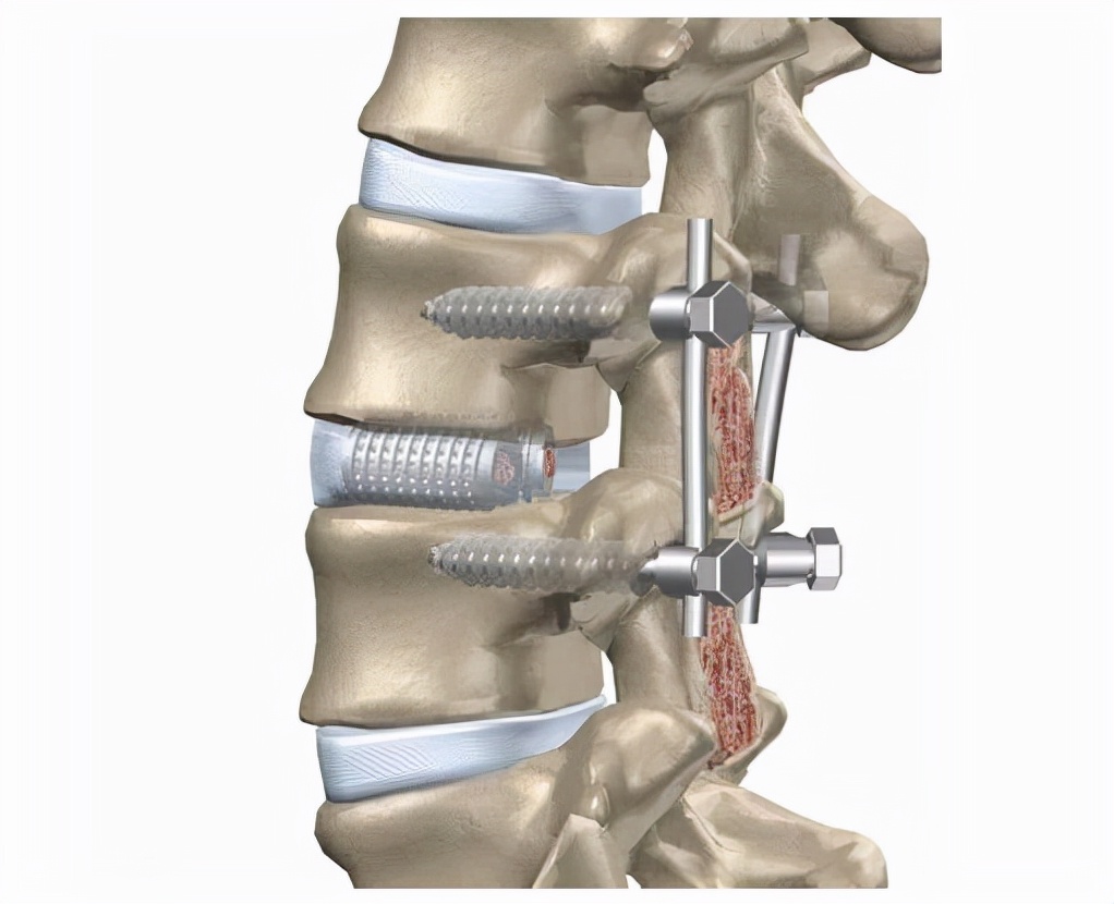 "I" do I need lumbar fixation and fusion surgery?Four aspects teach you