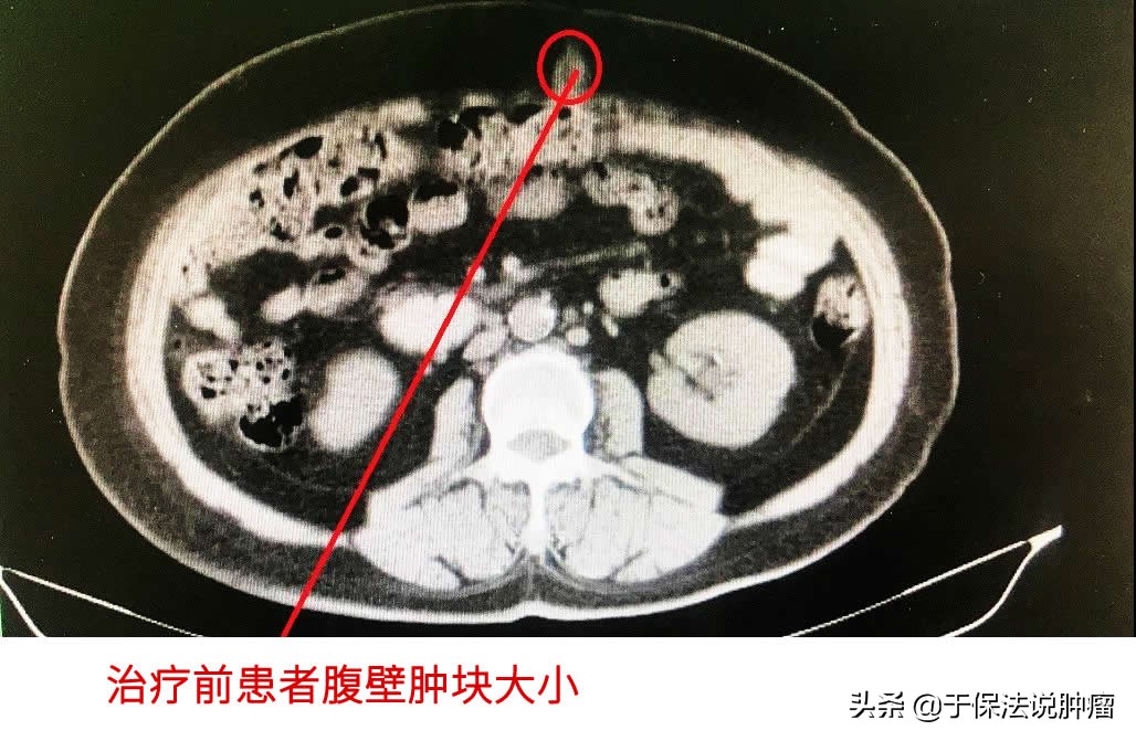 卵巢癌术后腹壁转移，缓释库超微创治疗病例诊治分享