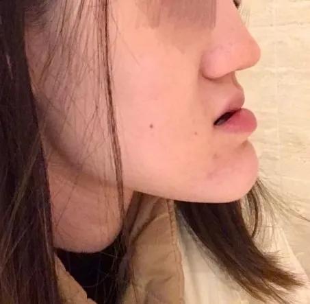 都说矫正要趁早,成年后 !--haodf:8:yahejixing-->地包天 !