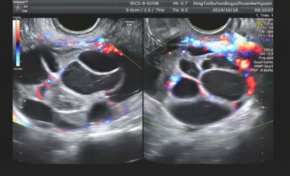 What happens to the ovaries before and after egg retrieval? iMedia