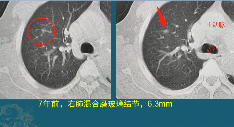 磨玻璃肺结节随访观察，会不会变成肺癌？医生带你看随访4种结局