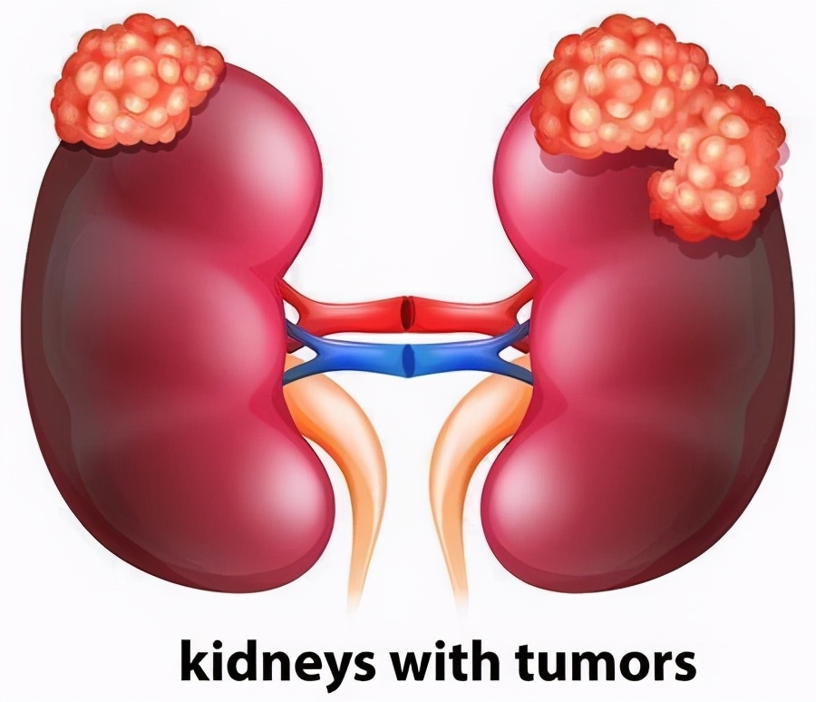 肾细胞癌一线治疗：免疫+靶向组合在欧盟获批