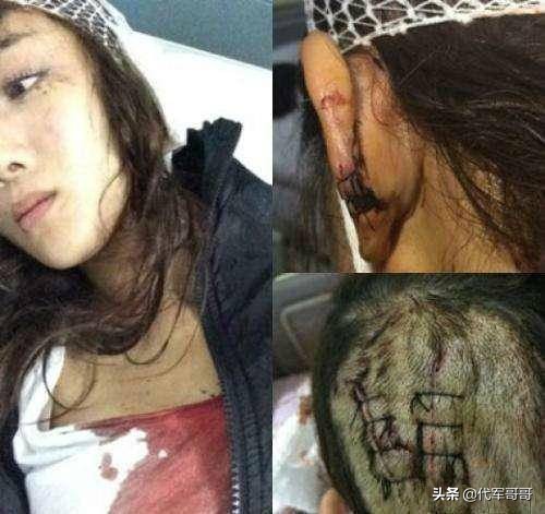 又一位32岁女星被狗咬伤！嘴唇缝9针险毁容，网友：看到都感觉疼