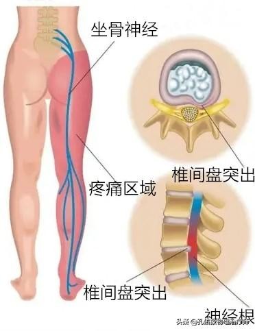 您的臀部伴下肢疼痛麻木 就是腰椎间盘突出吗 即使拍了片 也不一定哦 医生辟谣 教您如何判断病因及治疗 梨状肌综合征 梨状肌综合征