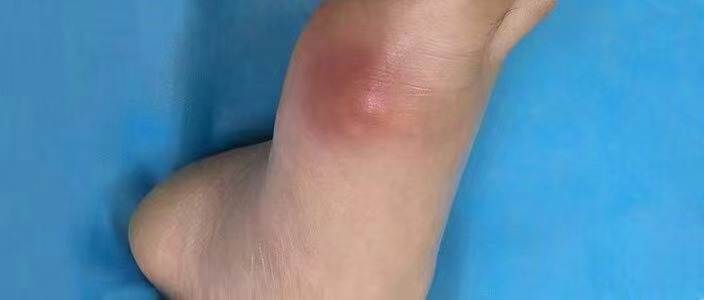 痛風的�自然療法�，安全又有效，你了解嗎