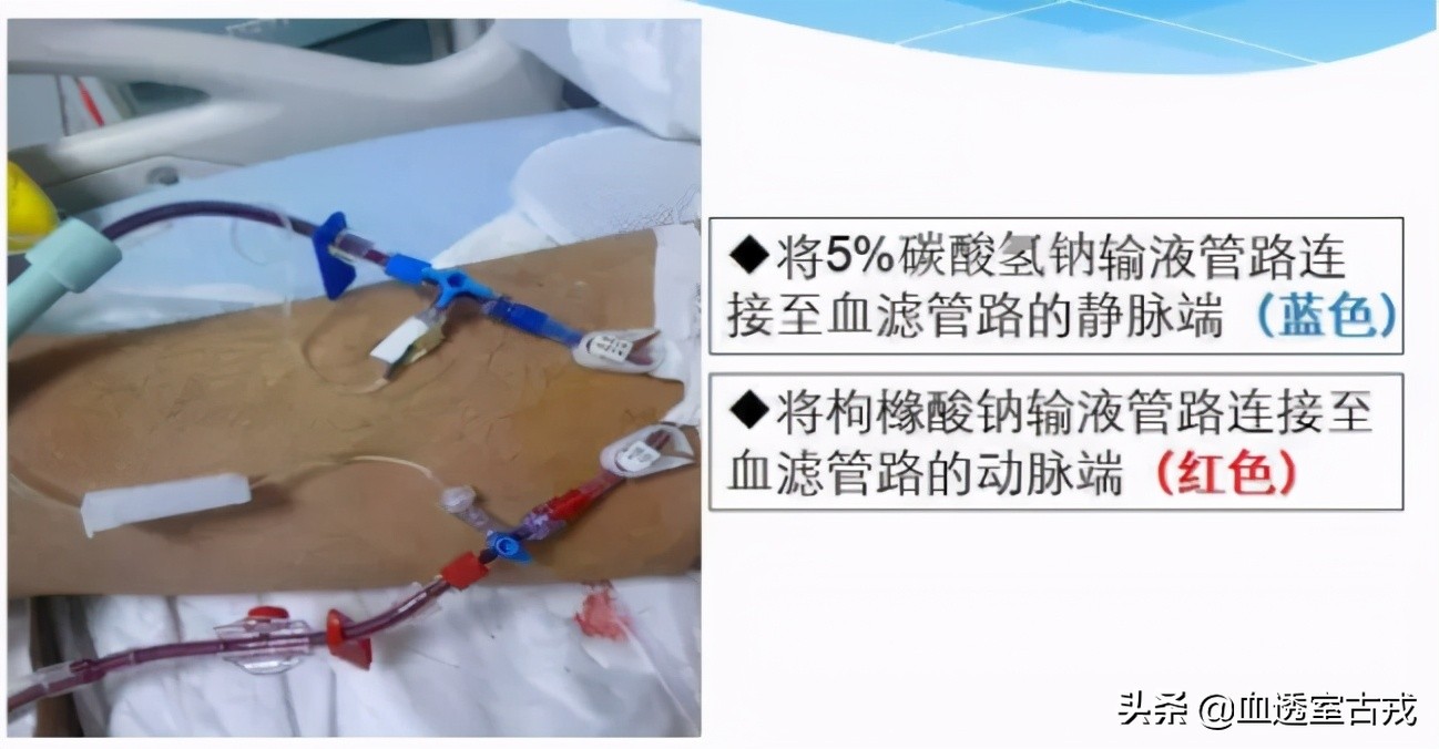 CRRT治疗中，分段枸橼酸钠体外抗凝效果如何？怎么用？