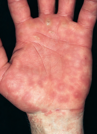 让人烦恼的荨麻疹是什么样的疾病？