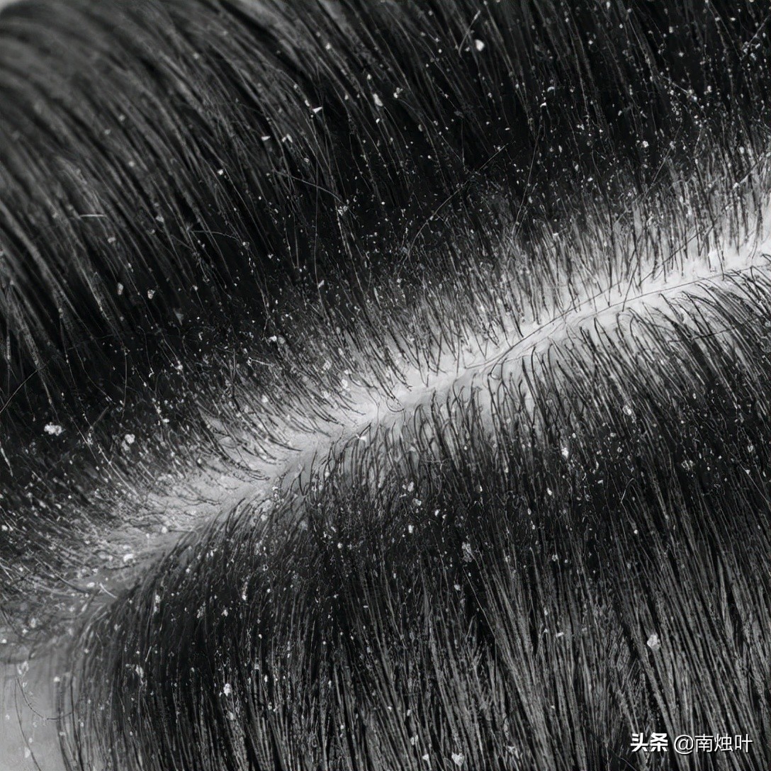 Why do people have dandruff?Excessive dandruff may have these effects ...