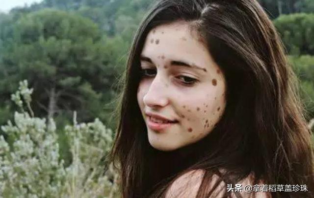 身上长有500多块胎记的女孩，曾被当怪物看待，