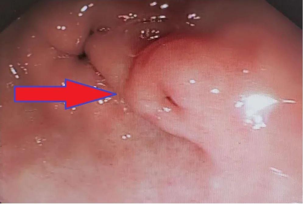 奇怪！胃里竟长出来个胰腺