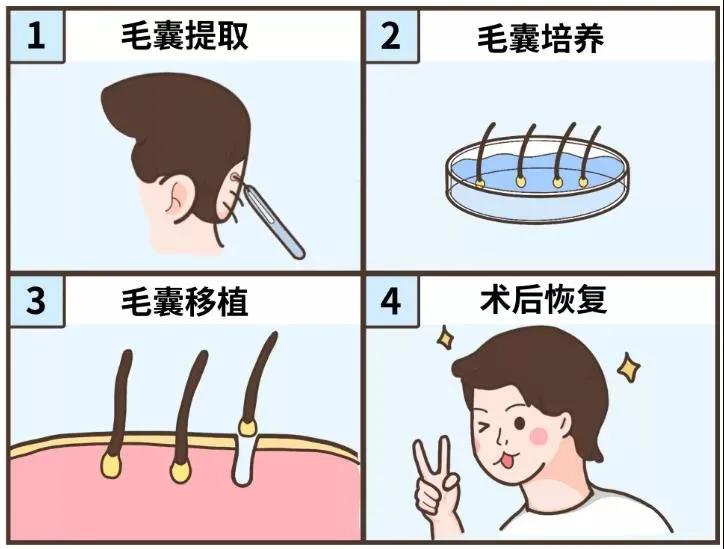 6个中国人就有1个脱发！“秃”然的惊喜：这样植发最有效！
