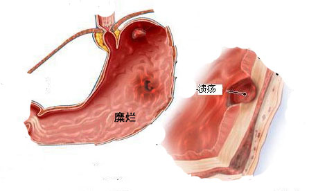 一文读懂胃糜烂：胃糜烂能治好吗？吃什么药好？需要吃多久？