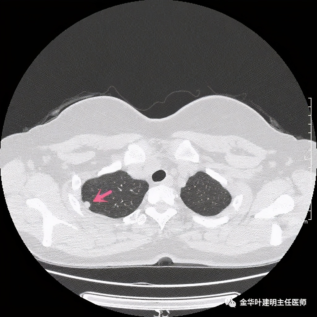 随访明显增大的实性<!--HAODF:8:jiejiebing-->肺结节<!--HAODF:/8:jiejiebing-->肯定是癌吗？要不要手术？