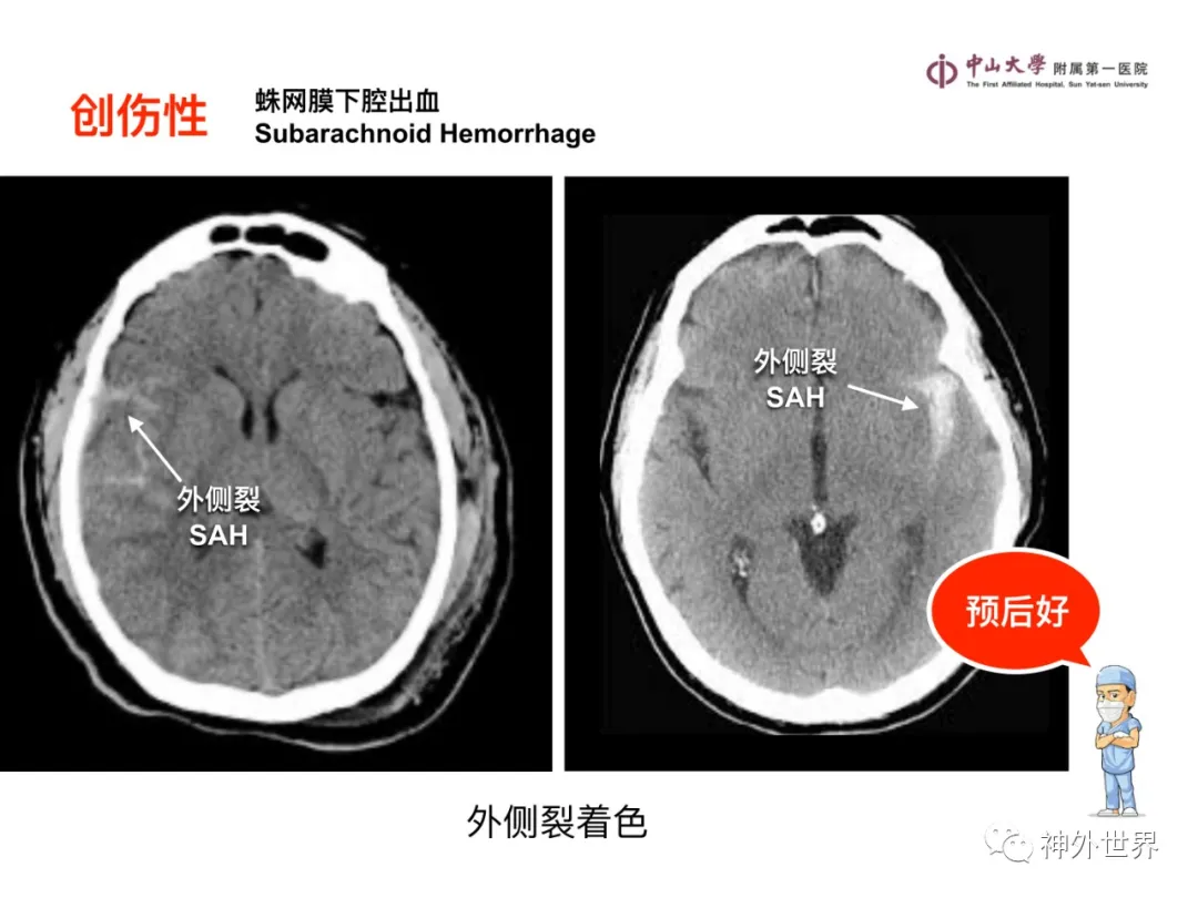 最全影像总结 | 颅内病变 MR、CT 的阅片技巧，太赞了