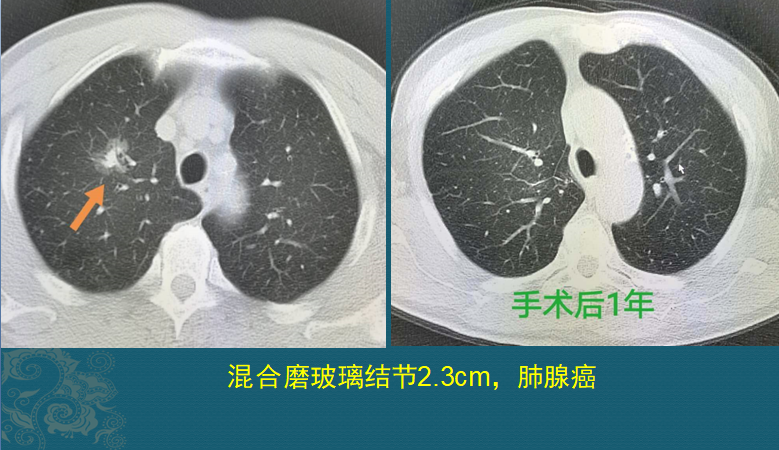 老人长5个肺癌，都不一样，有2个扩散，肺癌不能治愈吗？