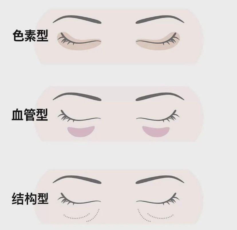 你的“黑眼圈”是怎样形成的？黑眼圈的3种类型，看完你就知道了