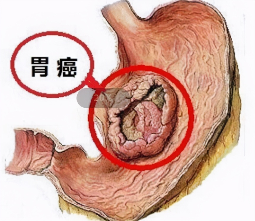 胃癌特效药第一三共Enhertu获批：显著延长患者生存