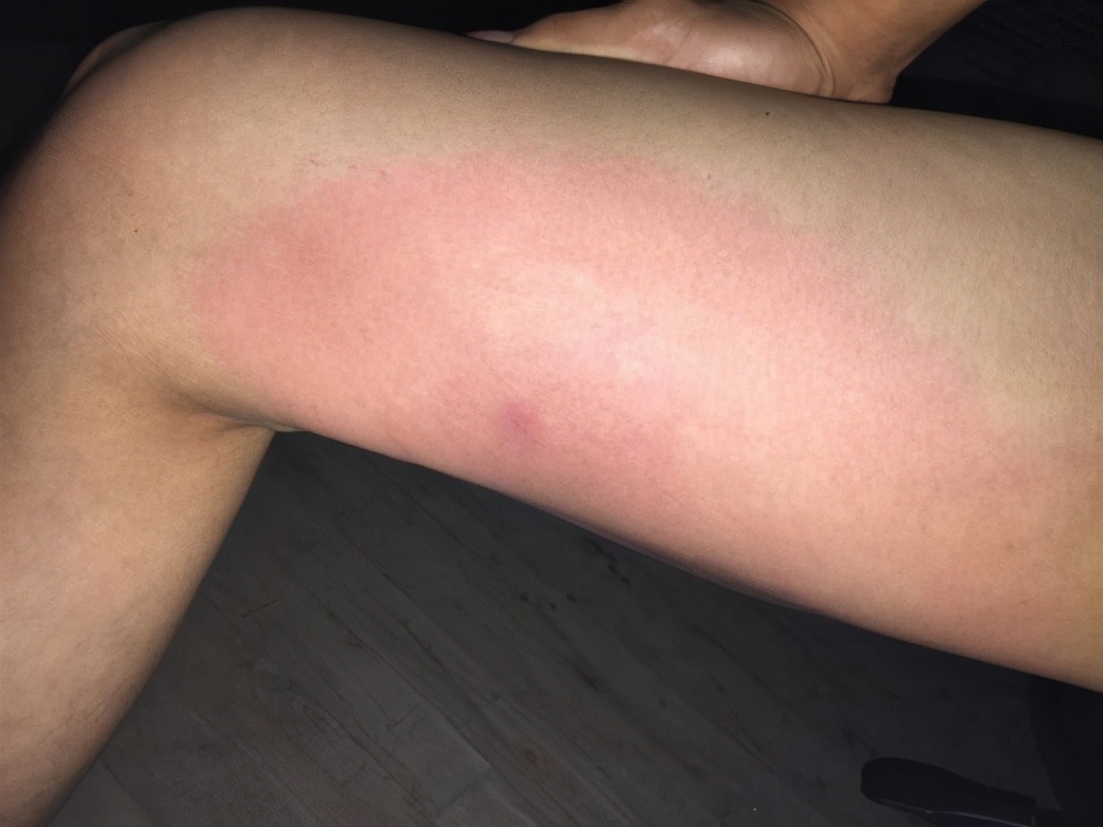 皮肤出现3大症状，说明糖尿病肾病来了！为家人健康早了解- 资讯咖