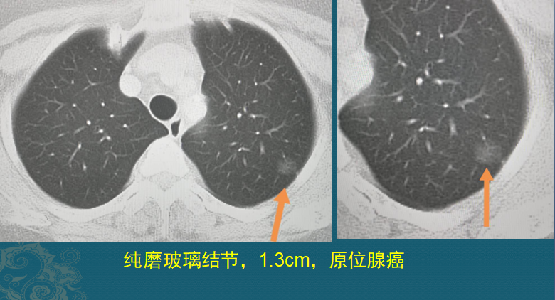 慢病界 老人长5个肺癌 都不一样 有2个扩散 肺癌不能治愈吗