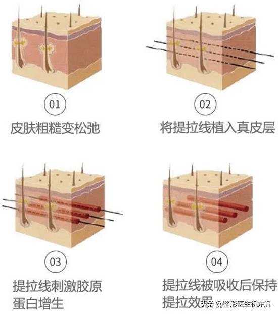 面部线雕术后，听见"咯噔一下"的响声，是不是线断了？