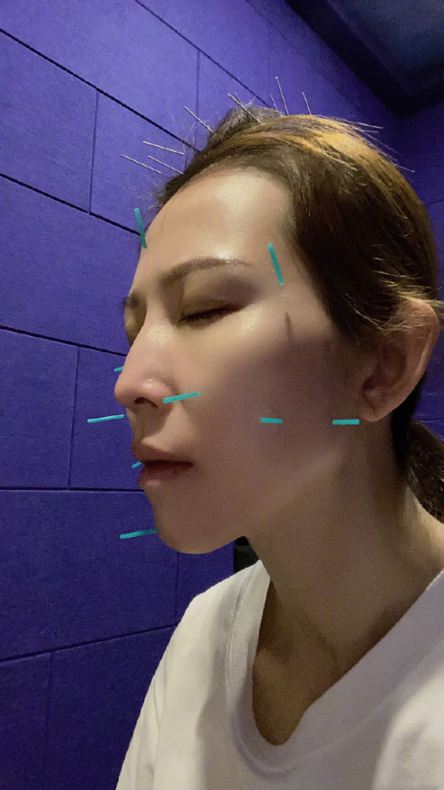 張晉蔡少芬臘八節做針灸，娘娘為保凍顏滿臉扎針，三個兒女齊出鏡