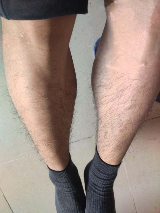 24歲魚鱗病小夥 年前終於完成了皮膚蜕變 魚鱗皮膚研究員張建 Mdeditor