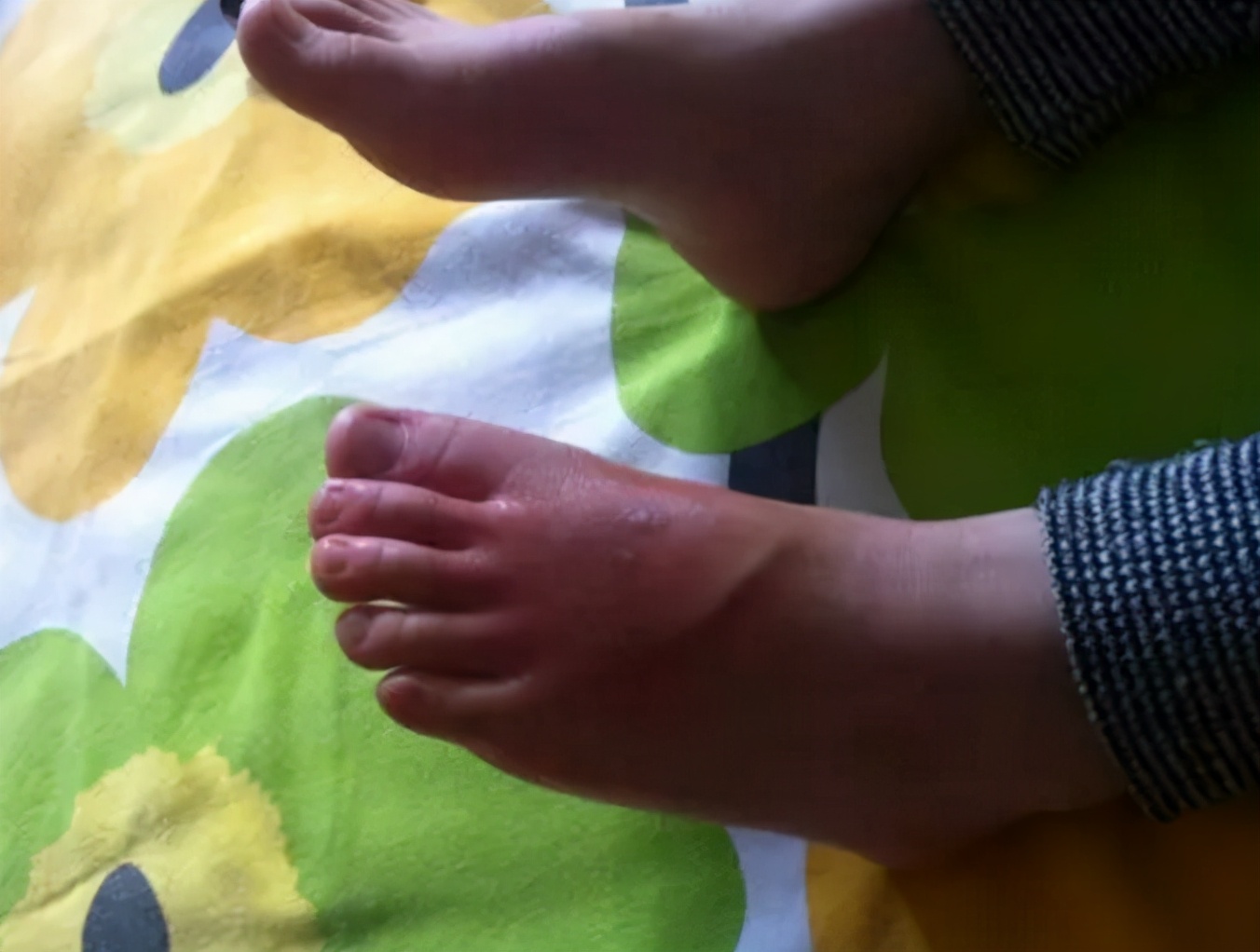 孩子被燙傷怎麼辦？ 事後兩分鐘為黃金救治時間，家長謹記這五步