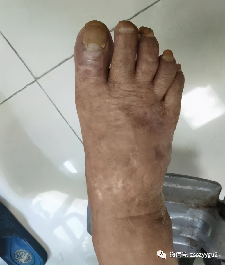 糖友最怕的爛腳有啥徵兆 能保肢嗎 醫學科普中心 Mdeditor