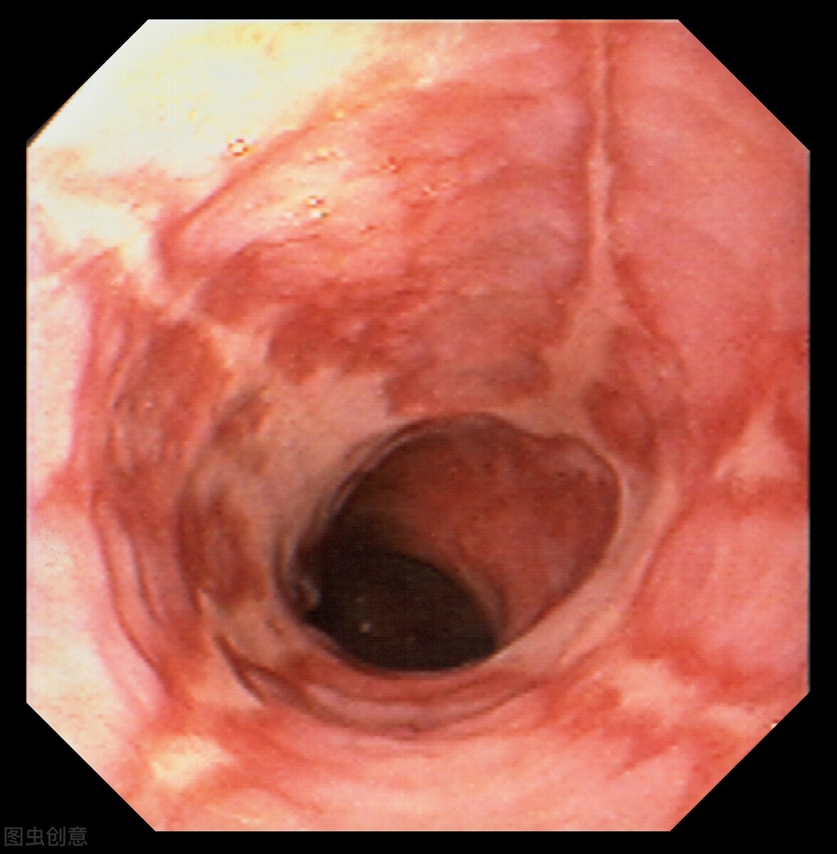 反流性食管炎3个危害 不能小看 8招预防反流性食管炎 西苑医院张如兰主任 Mdeditor