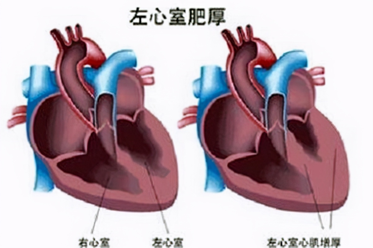 发现160～170的高血压3年未治，检查都发现了什么？