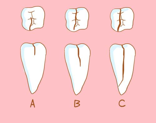 大连齿医生口腔科普 治疗牙隐裂的最佳方案