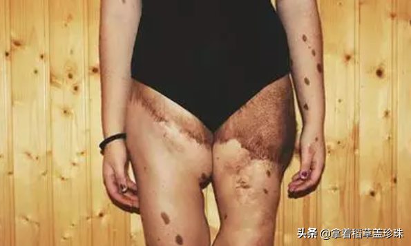 身上长有500多块胎记的女孩，曾被当怪物看待，